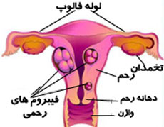 بیماری فیبروم رحمی,فیبروئیدهای رحم,علائم فیبروم رحمی