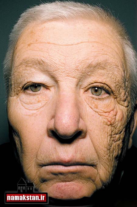 تاثیر مخرب نور خورشید روی پوست این مرد + عکس