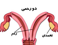 عارضه دو رحمی,علائم عارضه دو رحمی در زنان,علت داشتن دو رحم